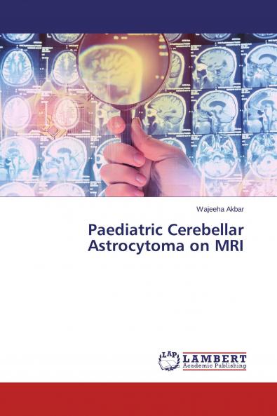 Paediatric Cerebellar Astrocytoma on MRI