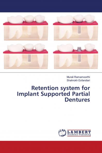 Retention system for Implant Supported Partial Dentures