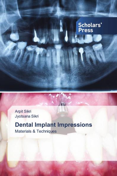 Dental Implant Impressions
