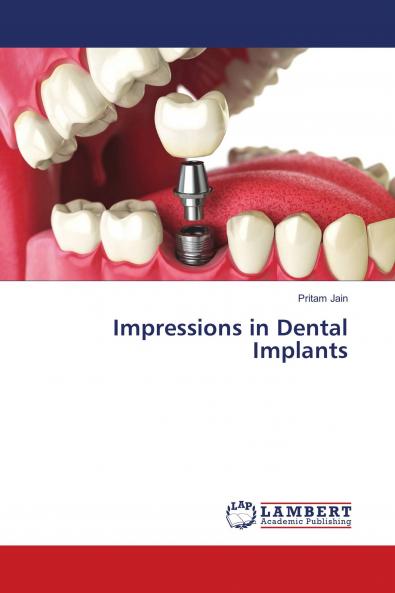 Impressions in Dental Implants