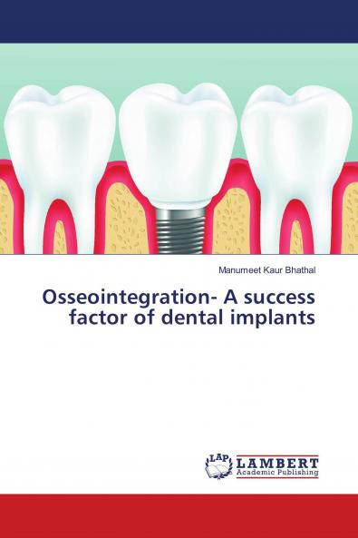 Osseointegration- A success factor of dental implants