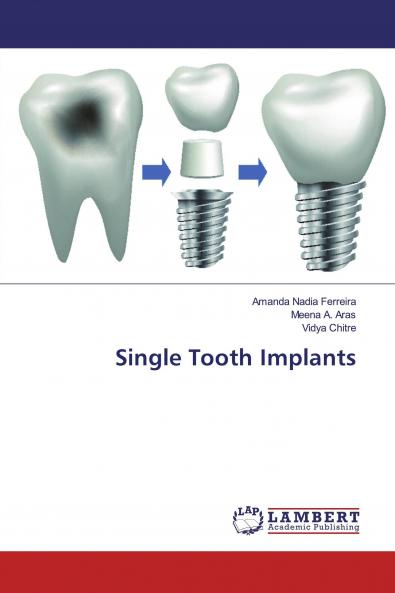 Single Tooth Implants