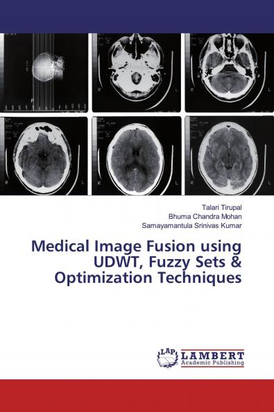 Medical Image Fusion using UDWT Fuzzy Sets & Optimization Techniques
