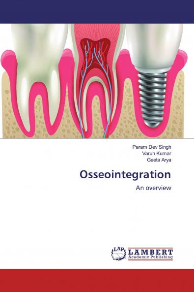 Osseointegration