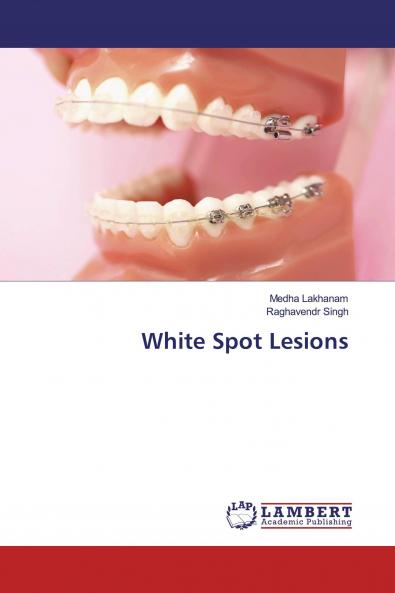 White Spot Lesions