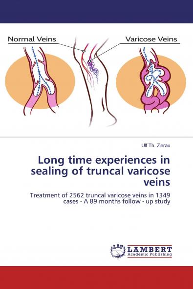 Long time experiences in sealing of truncal varicose veins