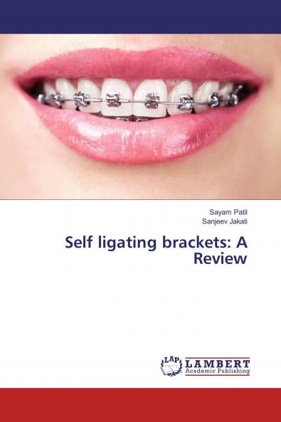 Self ligating brackets: A Review