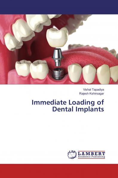 Immediate Loading of Dental Implants
