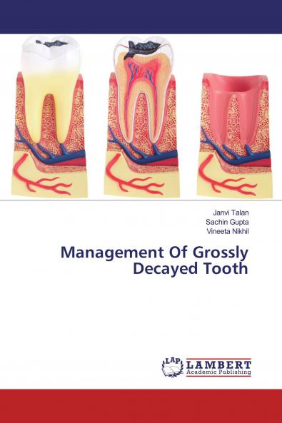 Management Of Grossly Decayed Tooth