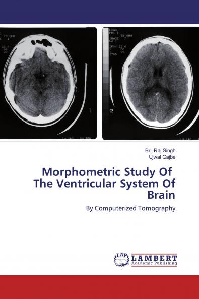 Morphometric Study Of The Ventricular System Of Brain