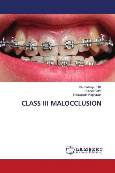 CLASS III MALOCCLUSION