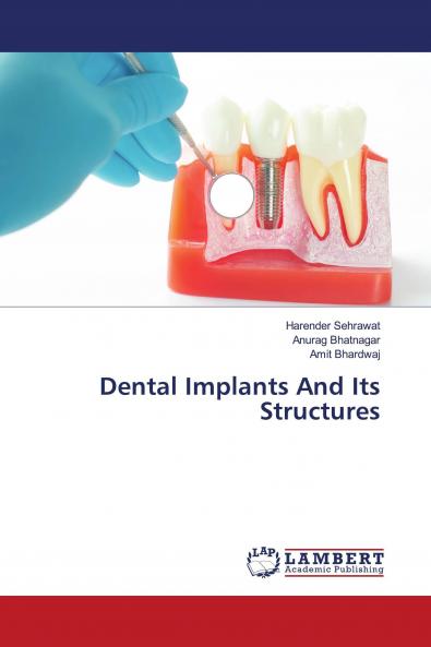 Dental Implants And Its Structures
