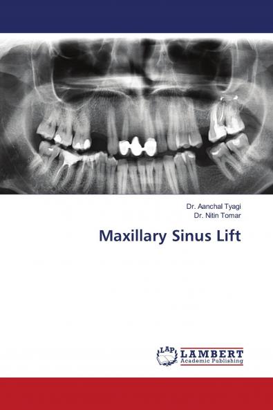 Maxillary Sinus Lift