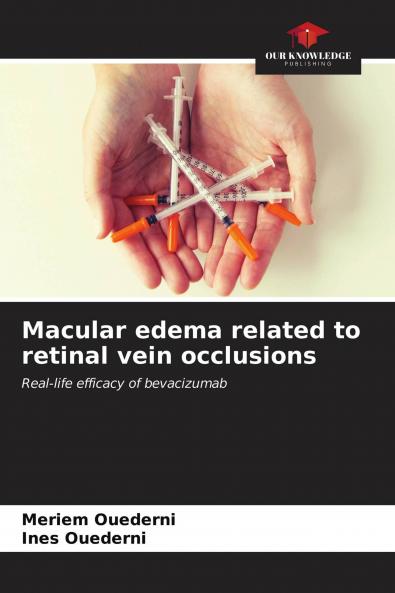 Macular edema related to retinal vein occlusions