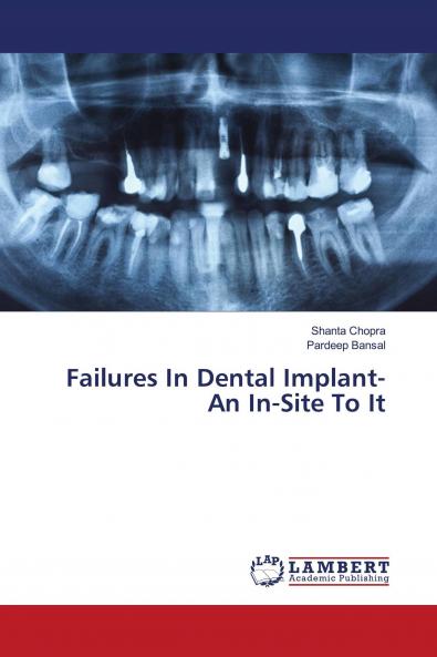 Failures In Dental Implant- An In-Site To It
