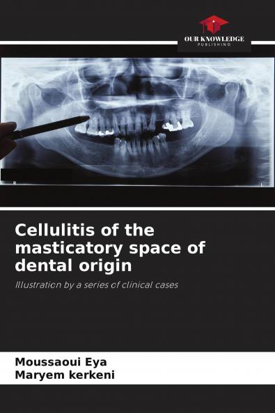 Cellulitis of the masticatory space of dental origin