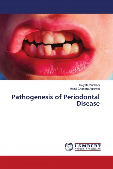 Pathogenesis of Periodontal Disease