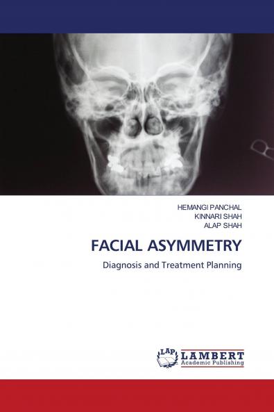 FACIAL ASYMMETRY