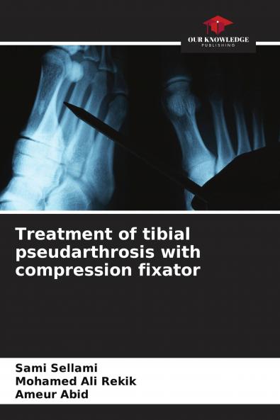 Treatment of tibial pseudarthrosis with compression fixator