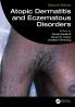 Atopic Dermatitis and Eczematous Disorders