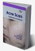 Acne Scars