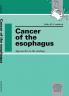 Cancer of the Esophagus