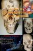 Guide To Craniomaxillofacial Osteosynthesis: Mini Plate And Screw
