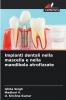 Impianti dentali nella mascella e nella mandibola atrofizzate