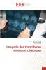 Imagerie des thromboses veineuses cérébrales