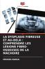 LA DYSPLASIE FIBREUSE ET AU-DELÀ