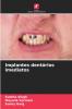Implantes dentários imediatos