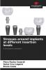 Stresses around implants at different insertion levels