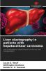 Liver elastography in patients with hepatocellular carcinoma