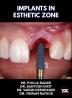 Implants In Esthetic Zone